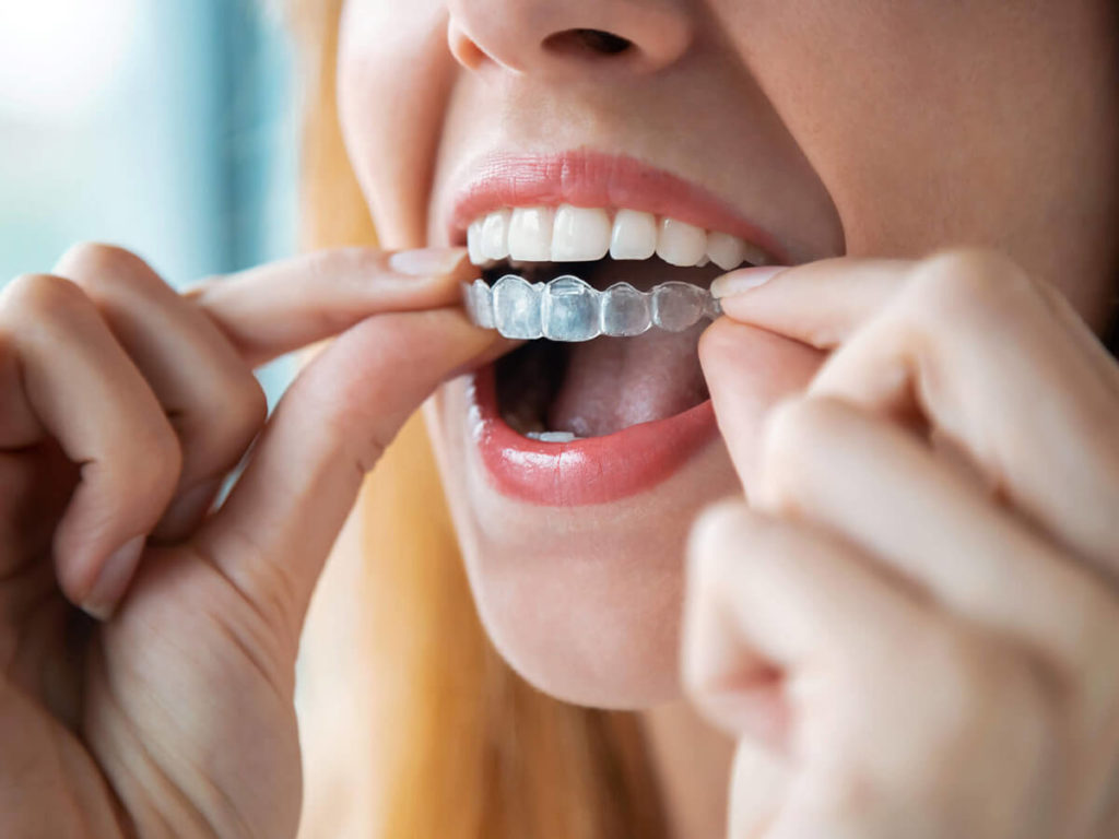 patient placing in clear aligner