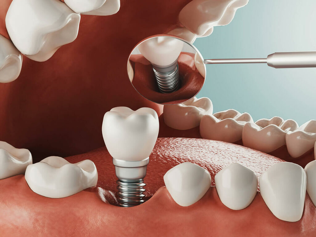 dental implant