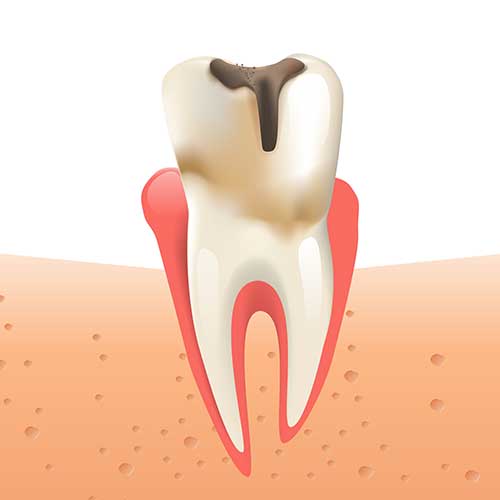 decaying tooth visual
