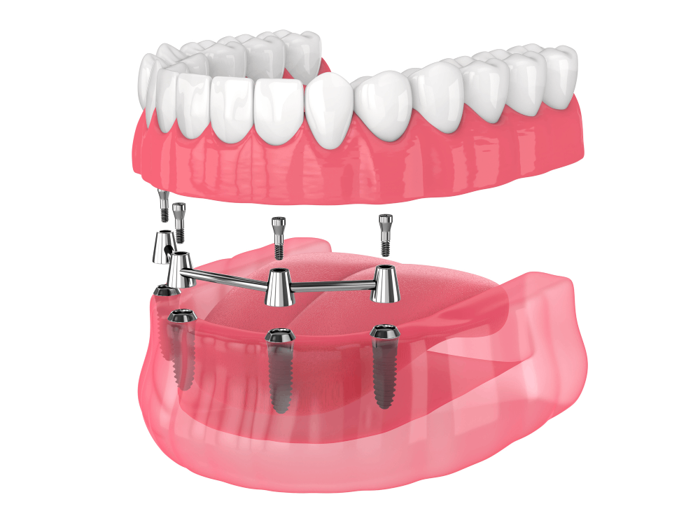 all on 4 dental implant mock up