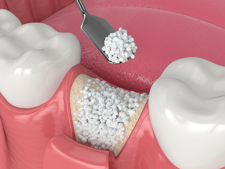 bone grafting visual representation